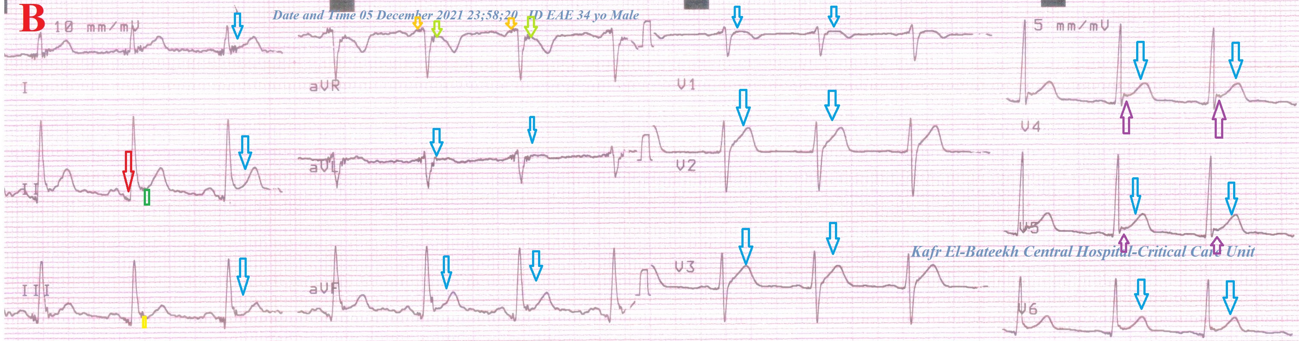 Acute Pericarditis With Movable Weaning Phenomenon Yassers Phenomenon